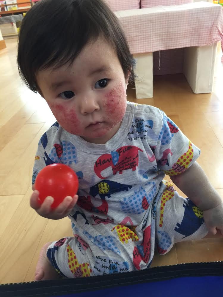 写真1<アトピー時期(0歳)>.JPG